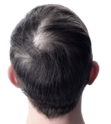before hair of a user of calvistop