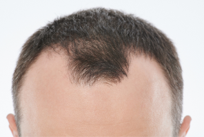 before hair of a user of calvistop