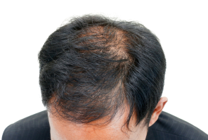 before hair of a user of calvistop