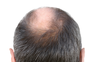 before hair of a user of calvistop