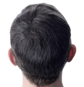 after hair of a user of calvistop