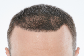 after hair of a user of calvistop
