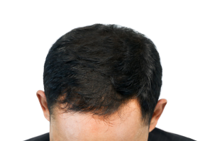 after hair of a user of calvistop
