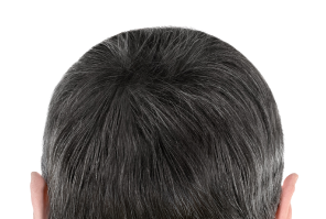 after hair of a user of calvistop