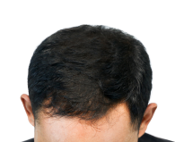 after hair of a user of calvistop