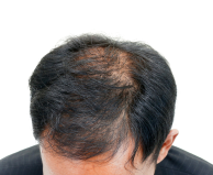 before hair of a user of calvistop