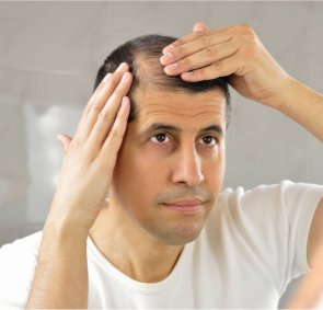 hair loss before illustration